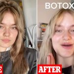 Botox Before and After: Incredible Transformations