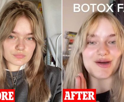 Botox Before and After: Incredible Transformations